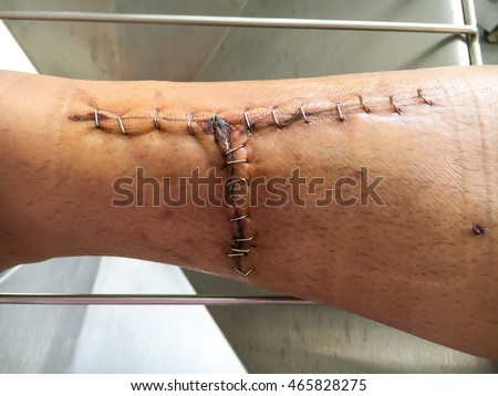 surgical stitches staple metal suture wound stitch modern section shutterstock birth scar
