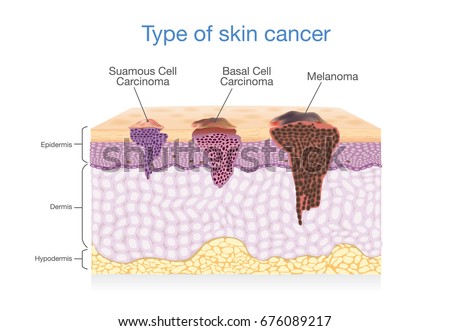 Skin Layer Have 3 Type Cancer Stock Vector 676089217 - Shutterstock