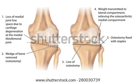 Triceps Brachii Muscle Labeled Stock Illustration 147943913 - Shutterstock