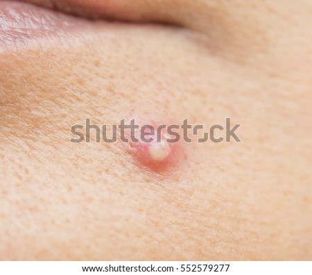 Acne Pus On Face Acne Pus On Face