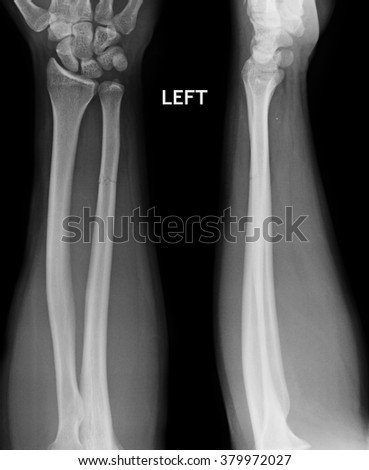 Fracture Shaft Radius Ulnar Bone Xray Stock Photo 379972027 - Shutterstock