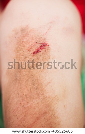 Large Hematoma Injection Upper Part Buttocks Stock Photo 57734275 ...