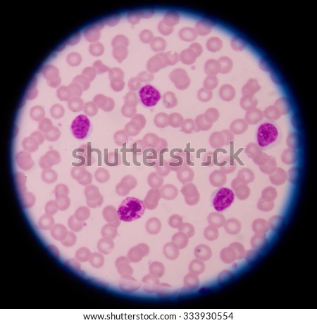 research paper on leukemia Leukemia research reports author information pack table of contents xxx original research articles are full-length research papers. research paper on leukemia Leukemia research reports author information pack table of contents xxx original research articles are full-length research papers.