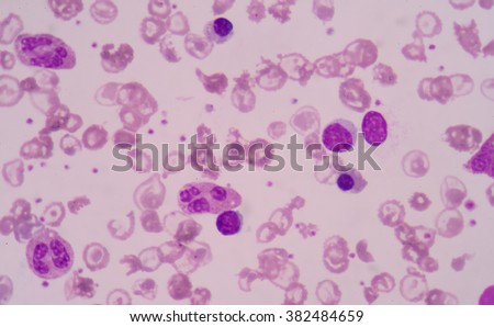 Sickle Cell Anemia Stock Images, Royalty-Free Images ...