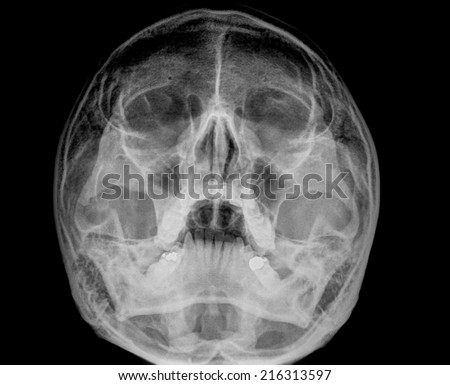 Film Xray Skull Nasal Bone Superoinferior Stock Photo 216313597 ...