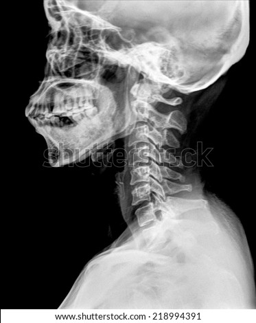 Calcification Stock Photos, Royalty-Free Images & Vectors - Shutterstock