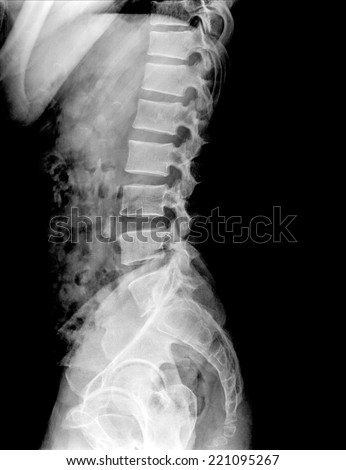 X Ray Human Lumbar Spine Lateral Stock Photo 221095267 - Shutterstock