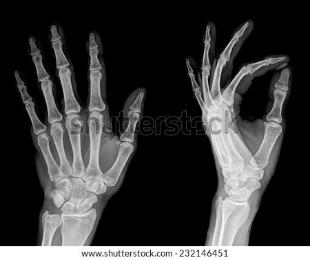 Human Left Hand Xray Medical Image Stock Photo (Royalty Free) 232146451 ...