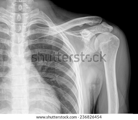 Regular Shoulder On Xray Stock Photo 236826454 - Shutterstock