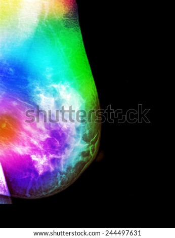 Opinion Mri breast cancer diagnosis can recommend Mri breast cancer diagnosis