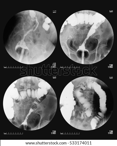 Rectum Stock Images, Royalty-Free Images & Vectors | Shutterstock