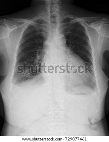 Chest Xray Image Pa Upright Position Stock Photo 729077461 - Shutterstock