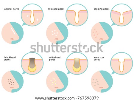 skin pores stock images royalty free images vectors whitehead stock images royalty free images vectors skin pores stock images royalty free images vectors whitehead stock images royalty free images vectors