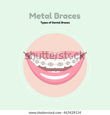 Download Metal Dental Braces Types Dental Braces Stock Vector ...