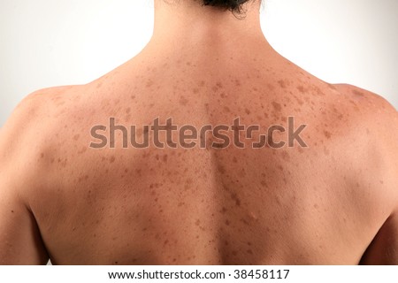 Back Spot Stock Photo 38458117 - Shutterstock