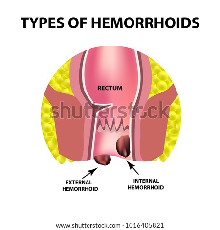 piles pictures and symptoms diagrams sphincter stock images royalty free images vectors piles pictures and symptoms diagrams sphincter stock images royalty free images vectors