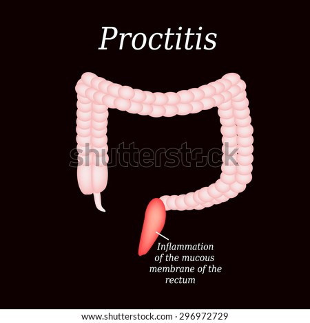 Proctitis Stock Images, Royalty-Free Images & Vectors | Shutterstock