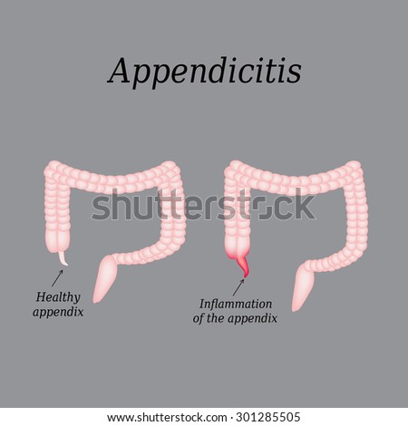 Appendicitis Stock Photos, Images, & Pictures | Shutterstock