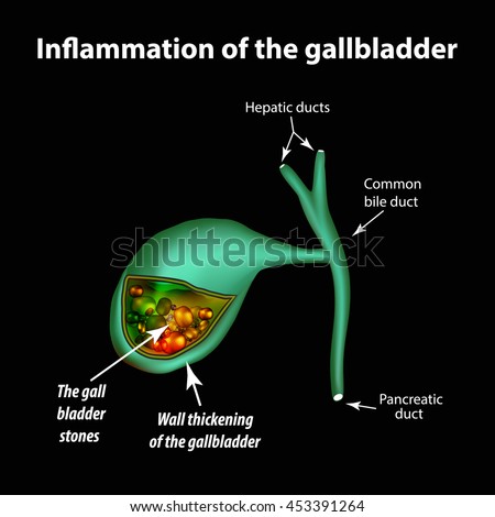 Gallstones Cholelithiasis Cholecystitis Inflammation Gallbladder ...