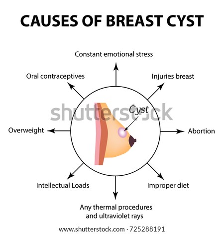 Cause of breast cysts