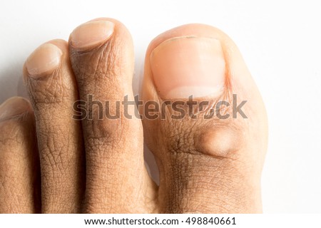 cracked callus on big toe