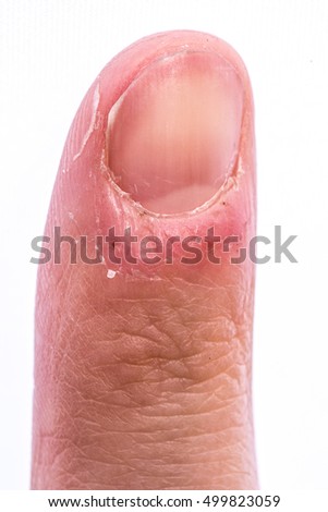 Fingernail Closeup Condition Called Leukonychia White Stock Photo ...