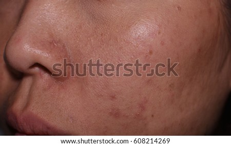 Smallpox Stock Images, Royalty-Free Images & Vectors | Shutterstock