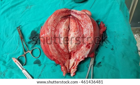 Hysterectomy Stock Images, Royalty-Free Images & Vectors | Shutterstock