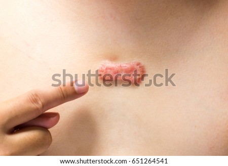 skin scar stock images royalty free images vectors keloid scar stock images royalty free images vectors skin scar stock images royalty free images vectors keloid scar stock images royalty free images vectors