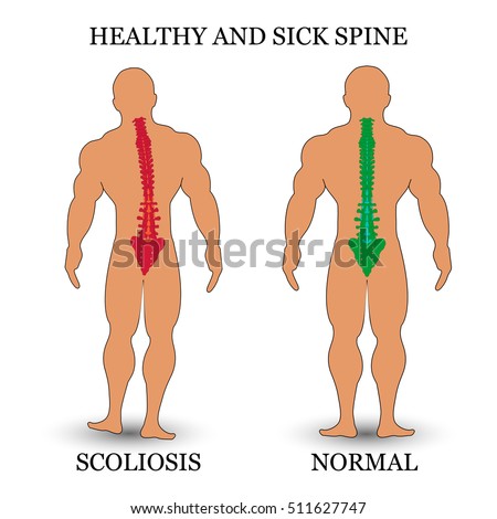 is scoliosis a medical condition