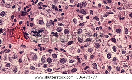 Cancer biopsy