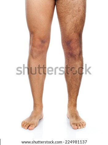 [Image: stock-photo-legs-of-a-man-his-right-leg-...981137.jpg]