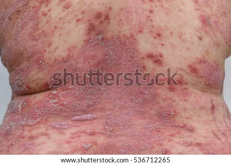 the role and causes of the inflammatory response of the human body Although the inflammatory process is beneficial in terms of helping the body to heal, sometimes localized swelling is a less helpful side-effect, so it is often treated by the use of ice, heat, compression, elevation and non-steroidal or steroidal anti-inflammatory medications. the role and causes of the inflammatory response of the human body Although the inflammatory process is beneficial in terms of helping the body to heal, sometimes localized swelling is a less helpful side-effect, so it is often treated by the use of ice, heat, compression, elevation and non-steroidal or steroidal anti-inflammatory medications.