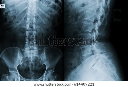 Film x-ray lumbar spine , L-S spine (AP,Lateral view) : Grade I/II spondylolithesis of L5-S1 , Decresed height of L5-S1 intervertebral disc space