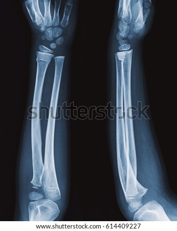 Film Child Xray Forearm Aplateral View Stock Photo 614409227 - Shutterstock