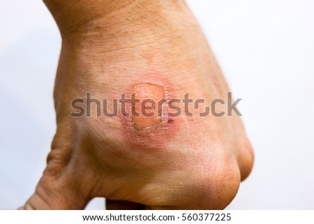 scar on human skin stock photo 97015703 skin scar stock images royalty free images vectors scar on human skin stock photo 97015703 skin scar stock images royalty free images vectors