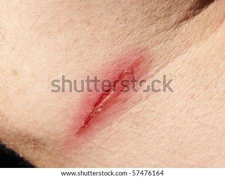 burn scar stock photo 57476164 burn scar stock photo 57476164 burn scar stock photo 57476164 burn scar stock photo 57476164
