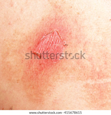 Macro Texture Burns On Human Skin Stock Photo 415678729 - Shutterstock