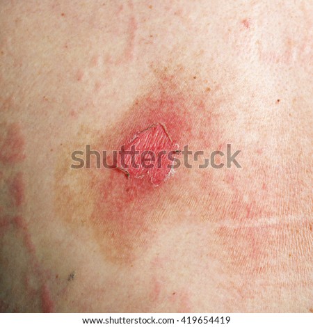macro texture burns on human skin stock photo 415678729 bite leg blood stock photo 306747611 macro texture burns on human skin stock photo 415678729 bite leg blood stock photo 306747611