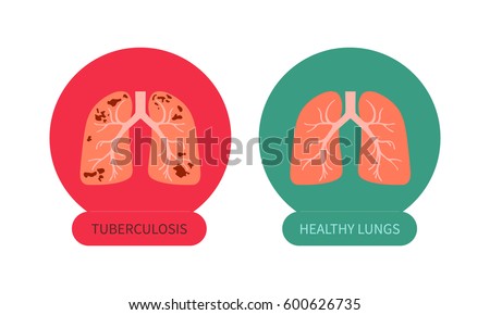 Picutes of tuberculosis