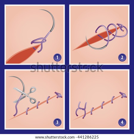 Suture Stock Images, Royalty-Free Images & Vectors | Shutterstock