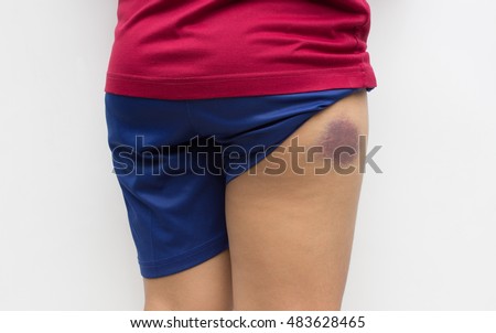 buttock healing scar fracture ankle operation after human falling stairs bruise cause background shutterstock