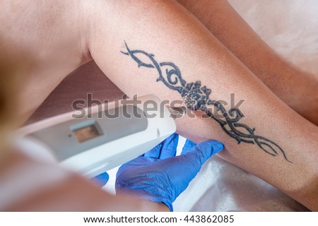 tattoo removal stock images royalty free images u0026 vectors tattoo removal stock images royalty free images u0026 vectors