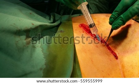 Open cholecystectomy operative report