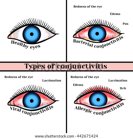 a look at major types of eye disorders Structure and function of the eyes and eye disorders eye disorders there are two main types of photoreceptors. a look at major types of eye disorders Structure and function of the eyes and eye disorders eye disorders there are two main types of photoreceptors.