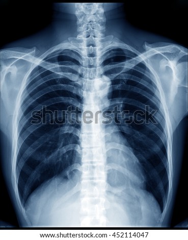 Chestxray Abnormalities Lung Abnormalities