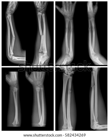 bone fracture and child A break of any size is called a fracture if the broken bone punctures the skin, it is called an open fracture (compound fracture) if a young child refuses to . bone fracture and child A break of any size is called a fracture if the broken bone punctures the skin, it is called an open fracture (compound fracture) if a young child refuses to .