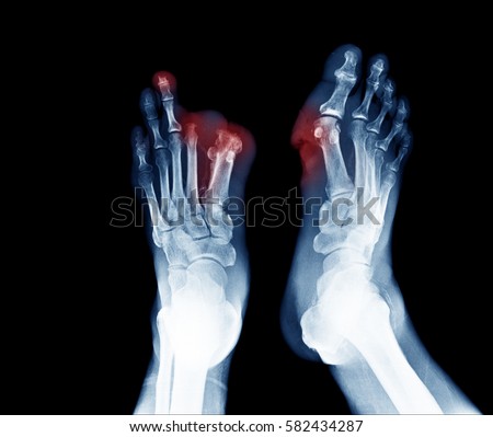 Xray Image Diabetic Foot Ulcer Show Stock Photo (Royalty Free ...