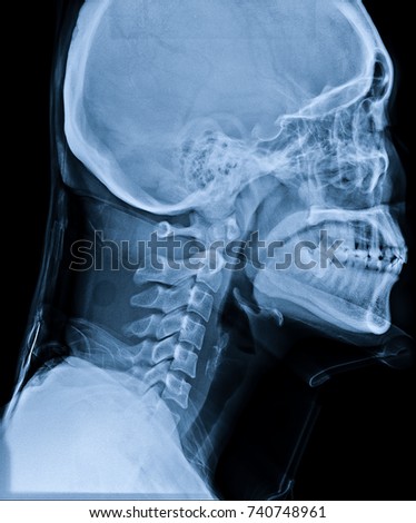 nude plus sized moman cervical spine and facial numbness
