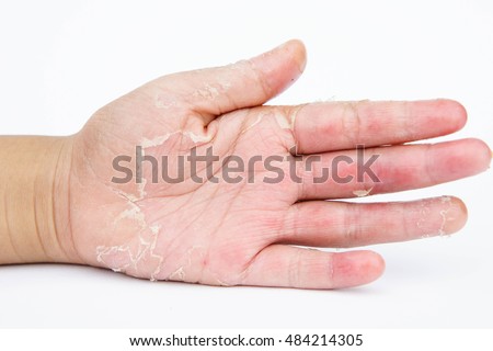 Fungal Infection Stock Images, Royalty-Free Images & Vectors | Shutterstock